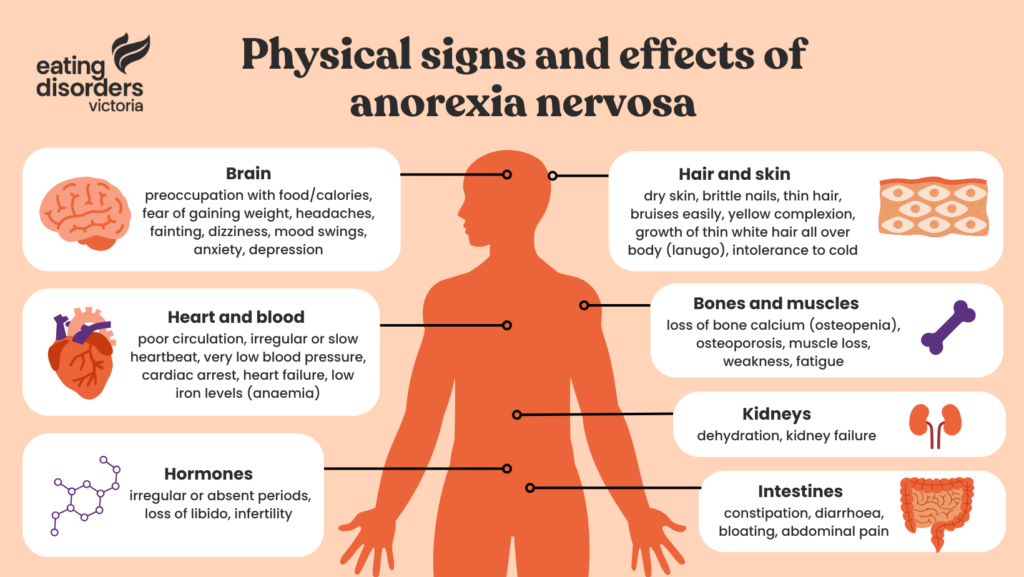 Physical signs and effects of anorexia nervosa